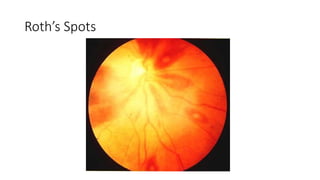 Endocarditis | PPTX