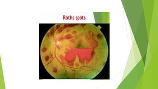 Nodule De Roth Endocarditis | PPTX