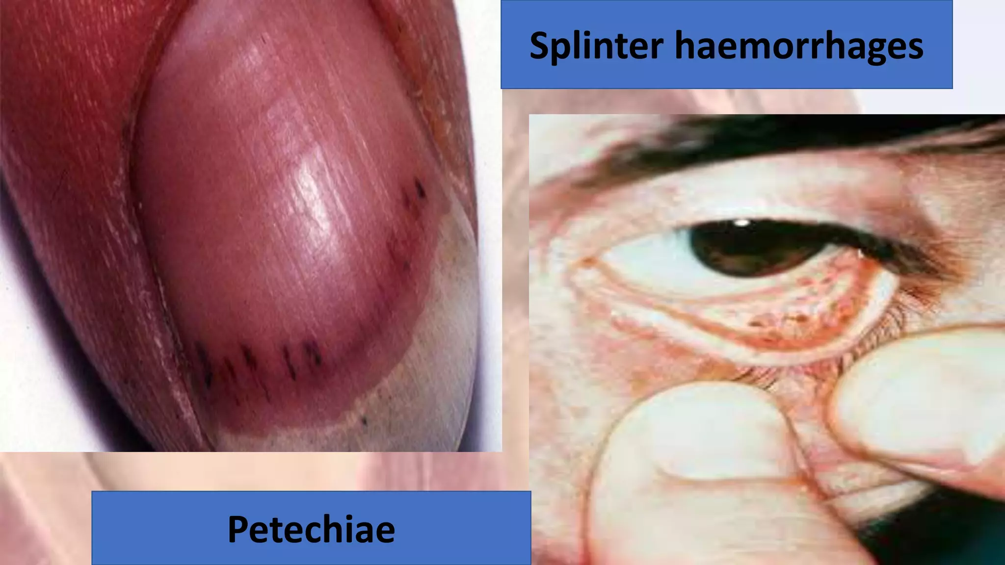 Endocarditis and its management | PPTX