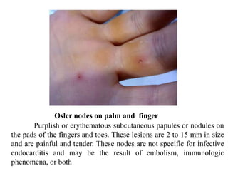 Osler nodes on palm and finger
Purplish or erythematous subcutaneous papules or nodules on
the pads of the fingers and toes. These lesions are 2 to 15 mm in size
and are painful and tender. These nodes are not specific for infective
endocarditis and may be the result of embolism, immunologic
phenomena, or both
 