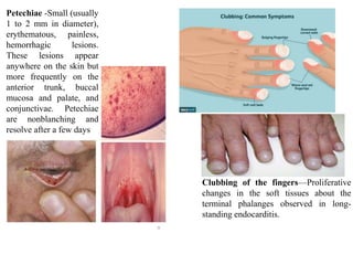 Clubbing of the fingers—Proliferative
changes in the soft tissues about the
terminal phalanges observed in long-
standing endocarditis.
Petechiae -Small (usually
1 to 2 mm in diameter),
erythematous, painless,
hemorrhagic lesions.
These lesions appear
anywhere on the skin but
more frequently on the
anterior trunk, buccal
mucosa and palate, and
conjunctivae. Petechiae
are nonblanching and
resolve after a few days
 