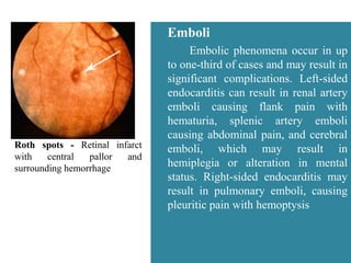 Roth spots - Retinal infarct
with central pallor and
surrounding hemorrhage
Emboli
Embolic phenomena occur in up
to one-third of cases and may result in
significant complications. Left-sided
endocarditis can result in renal artery
emboli causing flank pain with
hematuria, splenic artery emboli
causing abdominal pain, and cerebral
emboli, which may result in
hemiplegia or alteration in mental
status. Right-sided endocarditis may
result in pulmonary emboli, causing
pleuritic pain with hemoptysis
 