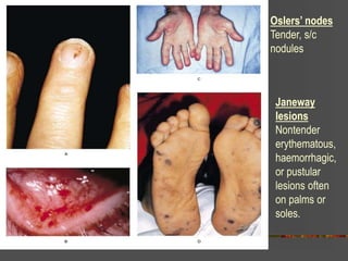 Oslers’ nodes
Tender, s/c
nodules
Janeway
lesions
Nontender
erythematous,
haemorrhagic,
or pustular
lesions often
on palms or
soles.
 