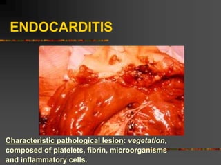 ENDOCARDITIS
Characteristic pathological lesion: vegetation,
composed of platelets, fibrin, microorganisms
and inflammatory cells.
 