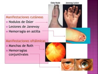 Manifestaciones cutáneas
 Nodulos de Osler
 Lesiones de Janeway
 Hemorragia en astilla
Manifestaciones oftálmicas
 Manchas de Roth
 Hemorragias
conjuntivales
 