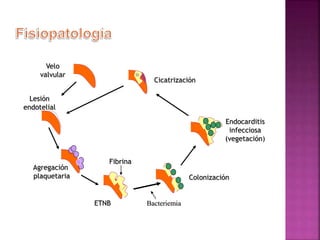 Lesión
endotelial
Agregación
plaquetaria
ETNB
Colonización
Endocarditis
infecciosa
(vegetación)
Bacteriemia
Velo
valvular
Cicatrización
Fibrina
 