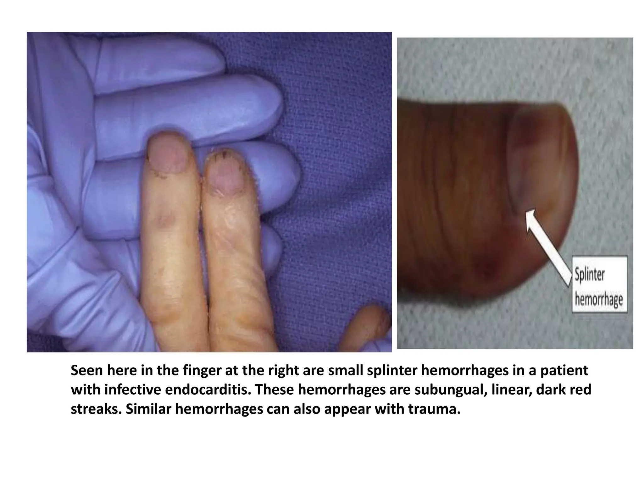 Infective Endocarditis (IE) Lecture pptx | PPTX