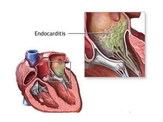 Endocarditis Animation Infective Endocarditis (IE) Lecture pptx | PPTX