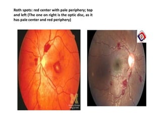 Red Periphery Infective Endocarditis (IE) Lecture pptx | PPTX