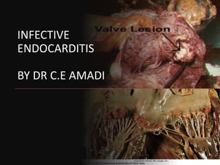 INFECTIVE
ENDOCARDITIS
BY DR C.E AMADI
 