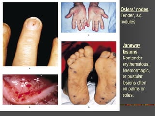 Oslers’ nodes
Tender, s/c
nodules
Janeway
lesions
Nontender
erythematous,
haemorrhagic,
or pustular
lesions often
on palms or
soles.
 