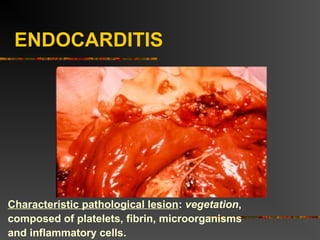 ENDOCARDITIS
Characteristic pathological lesion: vegetation,
composed of platelets, fibrin, microorganisms
and inflammatory cells.
 