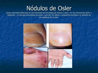Nódulos de Osler
áreas induradas dolorosas en los extremos de los dedos de manos y pies y en las eminencias tenar e
 hipotenar , a menudo precedidas de ardor o prurito. Se deben a pequeños trombos o a arteritis de
                                      los capilares de la piel.
 