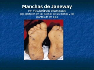 Manchas de Janeway
      son maculopápulas eritematosas
que aparecen en las palmas de las manos y las
             plantas de los pies
 