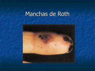 Manchas de Roth
 
