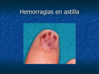 Hemorragias en astilla
 