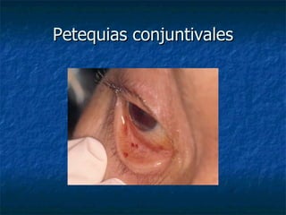 Petequias conjuntivales
 