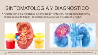 SINTOMATOLOGIA Y DIAGNOSTICO
• Aceleración de la velocidad de eritrosedirrientación, hipocomplementernia,
crioglobulina de tipo III, complejos inmunitarios circulantes y ANCA.
20XX 3
Harrison. Principios de Medicina Interna 20a. Ed. Trastornos renales y d
evías urinarias Capítulo 308. Enfermedades glomerulares 2020
 