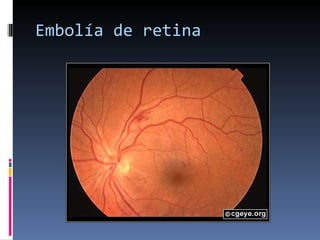 Embolía de retina 