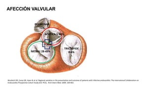 MITRAL 28-45%
AÓRTICA 5-36%
AÓRTICA 5-36%
MITRAL 28-45%
TRICUSPIDE
0-6%
PULMONAR
<1%
Murdoch DR, Corey GR, Hoen B, et al: Regional variation in the presentation and outcome of patients with infective endocarditis: The International Collaboration on
Endocarditis-Prospective Cohort Study (ICE–PCS). Arch Intern Med 2009; 169:463.
0-35%
AFECCIÓN VALVULAR
 