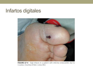 Infartos digitales
 