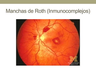 Manchas de Roth (Inmunocomplejos)
 