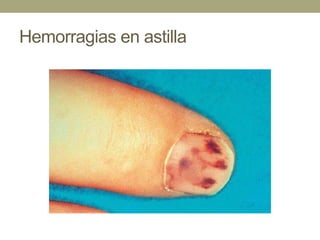 Hemorragias en astilla
 