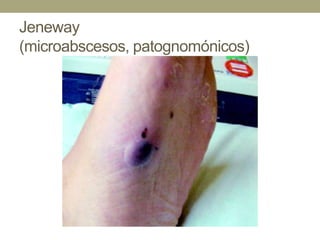 Jeneway
(microabscesos, patognomónicos)
 
