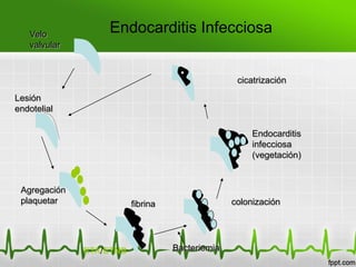 Velo
                  Endocarditis Infecciosa
   valvular


                                                  cicatrización

Lesión
endotelial

                                                      Endocarditis
                                                      infecciosa
                                                      (vegetación)


 Agregación
 plaquetar               fibrina                 colonización




              ETA/ETNB             Bacteriemia
 