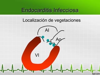 Endocarditis Infecciosa
Localización de vegetaciones

          AI

                Ao


     VI
 
