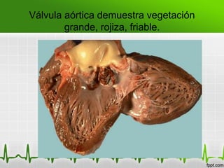 Válvula aórtica demuestra vegetación
        grande, rojiza, friable.
 