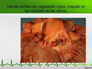 Válvula aórtica con vegetación rojiza, irregular en
           las cúspides de las valvas.
 
