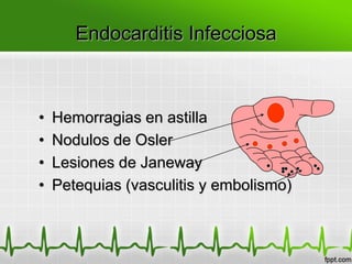 Endocarditis Infecciosa



•   Hemorragias en astilla
•   Nodulos de Osler
•   Lesiones de Janeway
•   Petequias (vasculitis y embolismo)
 