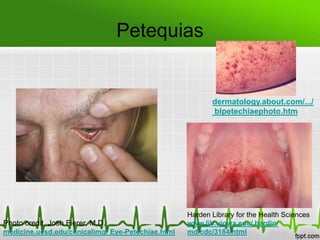 Petequias


                                                           dermatology.about.com/.../
                                                           blpetechiaephoto.htm




                                                    Harden Library for the Health Sciences
Photo credit, Josh Fierer, M.D.                     www.lib.uiowa.edu/ hardin/
medicine.ucsd.edu/clinicalimg/ Eye-Petechiae.html   md/cdc/3184.html
 