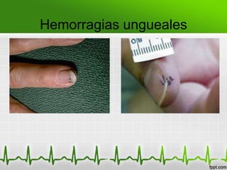 Hemorragias ungueales
 