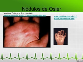 Nódulos de Osler
American College of Rheumatology
webrheum.bham.ac.uk/.../ default/pages/3b5.htm   www.meddean.luc.edu/.../
                                                 Hand10/Hand10dx.html
 