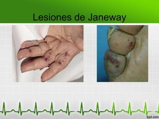 Lesiones de Janeway
 