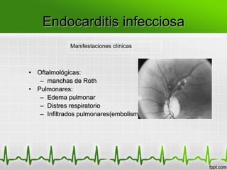 Endocarditis infecciosa
             Manifestaciones clínicas



• Oftalmológicas:
   – manchas de Roth
• Pulmonares:
   – Edema pulmonar
   – Distres respiratorio
   – Infiltrados pulmonares(embolismo)
 