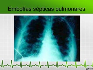 Embolías sépticas pulmonares
 