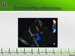 Endocarditis infecciosa
 