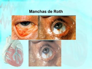 Manchas de Roth
 