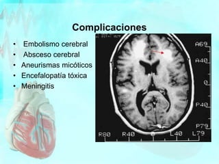 Complicaciones
• Embolismo cerebral
• Absceso cerebral
• Aneurismas micóticos
• Encefalopatía tóxica
• Meningitis
 
