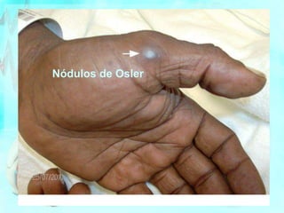 Nódulos de Osler
 