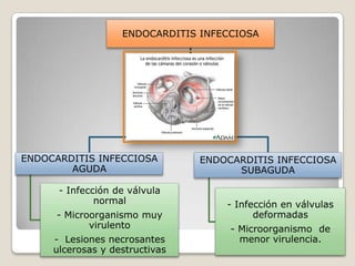 ENDOCARDITIS INFECCIOSA

ENDOCARDITIS INFECCIOSA
AGUDA
- Infección de válvula
normal
- Microorganismo muy
virulento
- Lesiones necrosantes
ulcerosas y destructivas

ENDOCARDITIS INFECCIOSA
SUBAGUDA
- Infección en válvulas
deformadas
- Microorganismo de
menor virulencia.

 