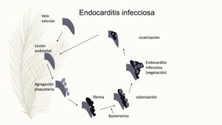 Lesión
endotelial
Agregación
plaquetaria
colonización
Endocarditis
infecciosa
(vegetación)
Endocarditis infecciosa
Bacteriemia
Velo
valvular
cicatrización
fibrina
 