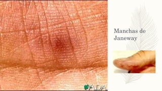 Manchas de
Janeway
 