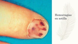 Hemorragias
en astilla
 