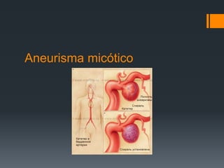 Aneurisma micótico
 