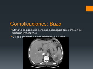 Complicaciones: Bazo
 Mayoría de pacientes tiene esplenomegalia (proliferación de
folículos linfocitarios)
 Se ha observado ruptura espontánea de bazo
 