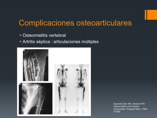 Complicaciones osteoarticulares
 Osteomielitis vertebral
 Artritis séptica : articulaciones múltiples
Speechly-Dick ME, Swanton RH.
Osteomyelitis and infective
endocarditis. Postgrad Med J 1994;
70:885.
 